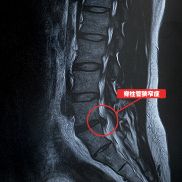 02：脊柱管狭窄症・椎間板ヘルニアに対応